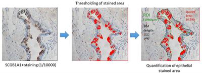 Club Cell Loss as a Feature of Bronchiolization in ILD